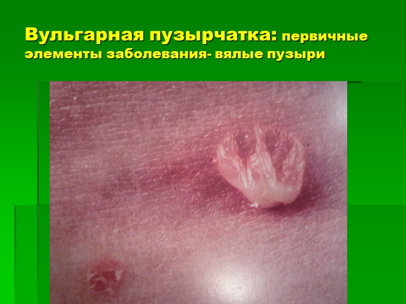 Вульгарная пузырчатка: первичные элементы заболевания- вялые пузыри